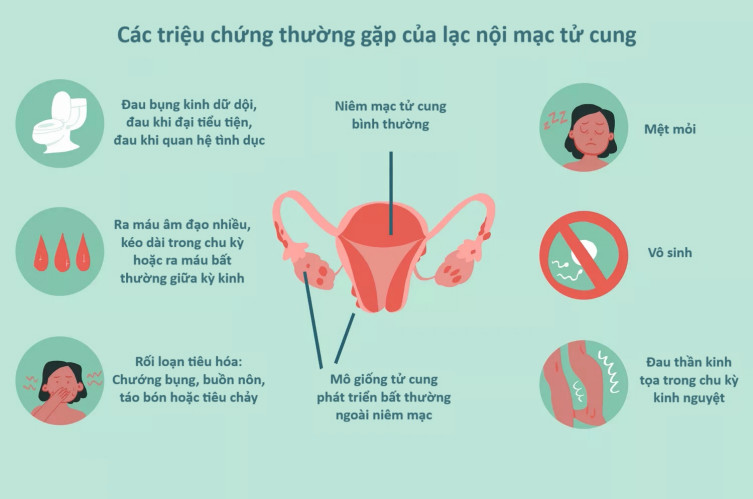 Triệu chứng của lạc nội mạc tử cung