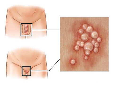 Triệu Chứng và Nguyên Nhân của Herpes Sinh Dục khá đa dạng và dễ nhận biết