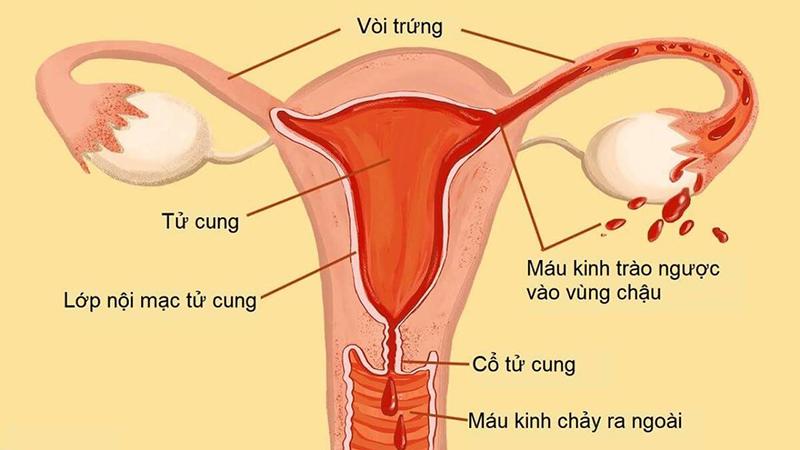 Nguyên nhân của u lạc nội mạc tử cung ở buồng trứng