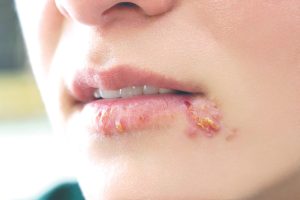 Virus herpes sinh dục có thể lây lan qua đường quan hệ tình dục bằng miệng