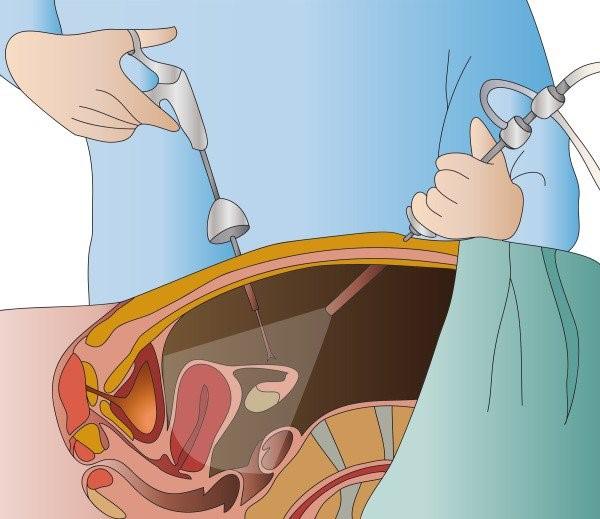 Chẩn đoán u lạc nội mạc tử cung ở buồng trứng