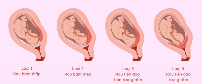 Có 4 loại rau tiền đạo tùy vị trí rau thai