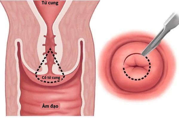 Phương pháp khoét chóp trong điều trị ung thư cổ tử cung giai đoạn I.