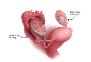 Hội chứng buồng trứng đa nang ở phụ nữ