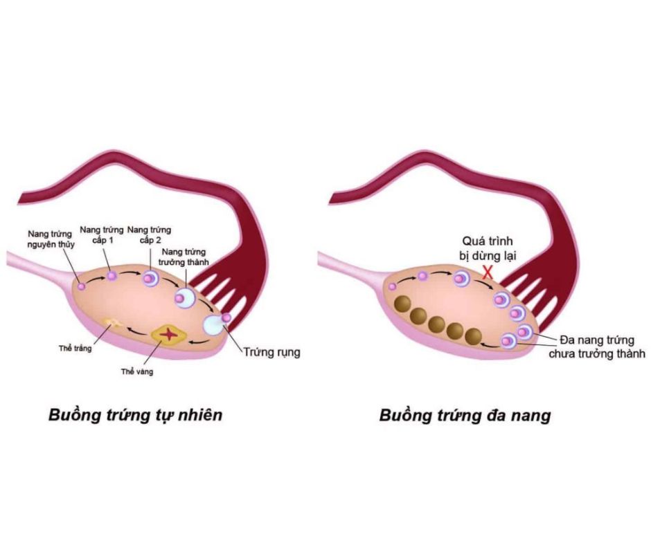 Bị đa nang buồng trứng có nguy hiểm không