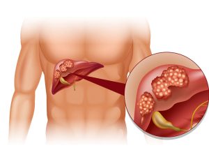 U nang: những điều cần biết để phòng ngừa