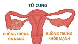 Buồng trứng đa nang