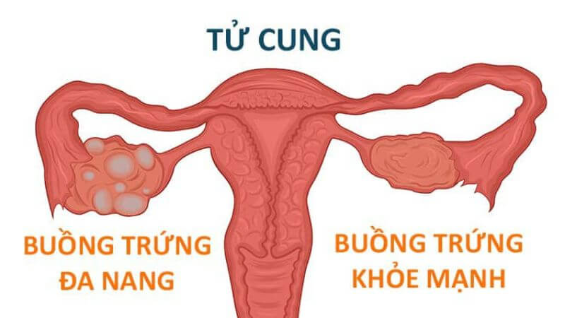 Buồng trứng đa nang