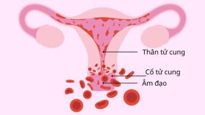 Chảy máu âm đạo bất thường: Chị em nên làm gì?