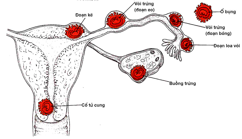 Vị trí thường gặp thai ngoài tử cung.