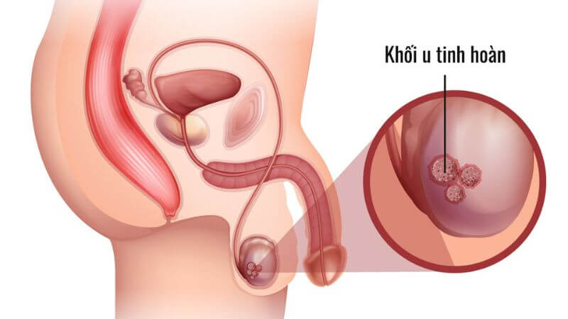 Khối u tinh hoàn có thể gây ra đau bụng dưới ở nam giới sau quan hệ