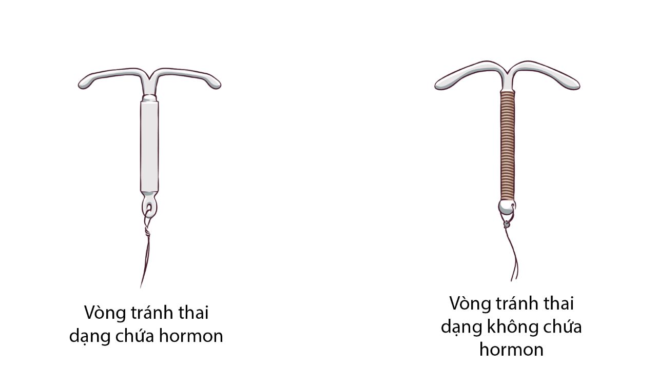 Vòng tránh thai bằng đồng là nguyên nhân gây ra khí hư màu nâu trong 3 tháng đầu tiên