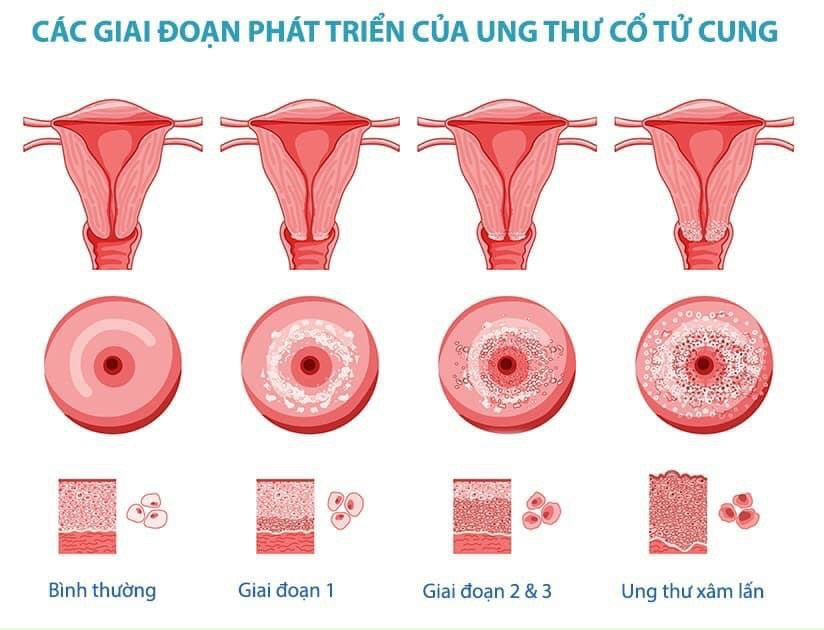 Giai đoạn tiến triển của ung thư cổ tử cung.