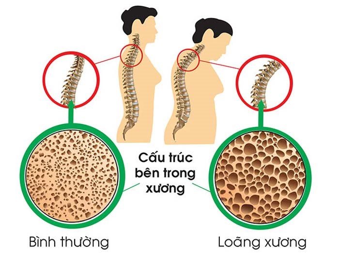 Tình trạng loãng xương do mãn kinh sớm.