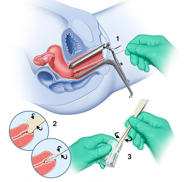 Quy trình thực hiện PAP test.