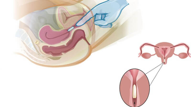 Người bệnh tiến hành đặt thuốc vào âm đạo trước khi đi ngủ