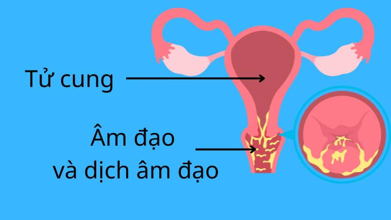 Khí hư là dịch xuất phát từ âm đạo