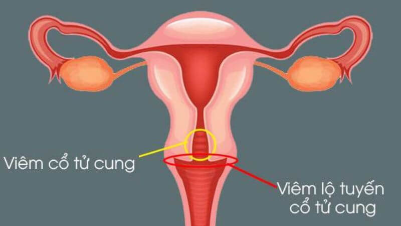 Viêm lộ tuyến cổ tử cung gây ra khí hư màu hồng nhạt với số lượng lớn