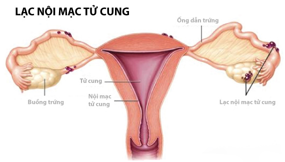 Lạc nội mạc tử cung là một bệnh lý lành tính