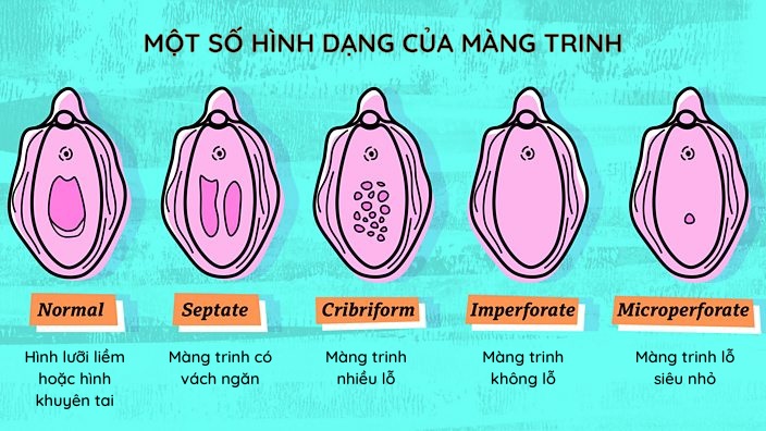 Màng trinh không thủng gây ra tình trạng bế kinh