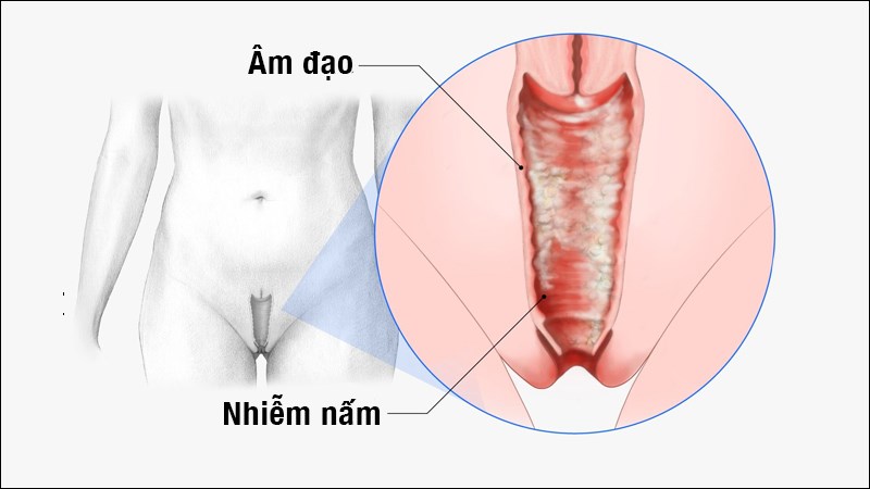 Triệu chứng của nấm âm đạo.