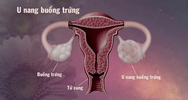 U nang buồng trứng trái