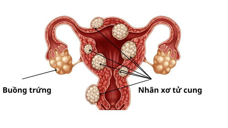 Các tế bào cơ ở tử cung phát triển bất thường tạo thành khối u