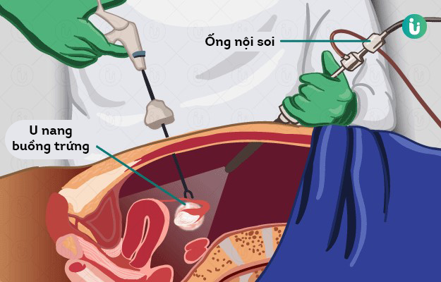  Phẫu thuật nội soi điều trị nang buồng trứng