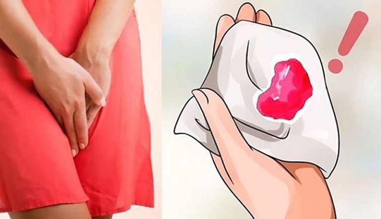 Hiện tượng ra máu sau mãn kinh: Nguyên nhân, chẩn đoán