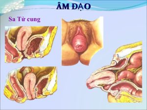 Nguyên nhân và biểu hiện sa tử cung