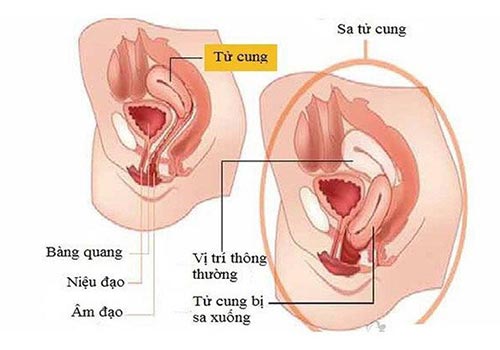 Sa tử cung sau sinh