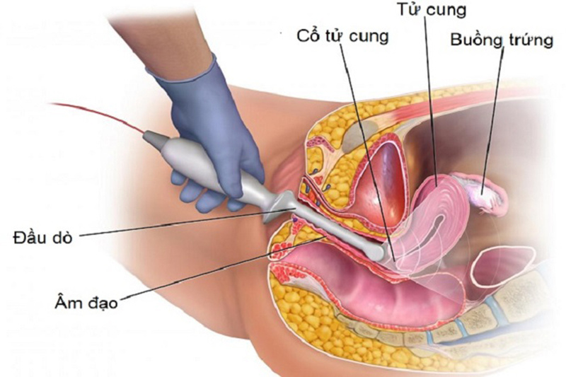 Siêu âm đầu dò âm đạo là phương pháp đơn giản dễ thực hiện.