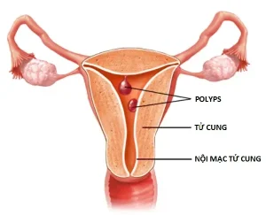 Hiện tượng ra máu sau mãn kinh do tăng sản niêm mạc tử cung dạng polyp.