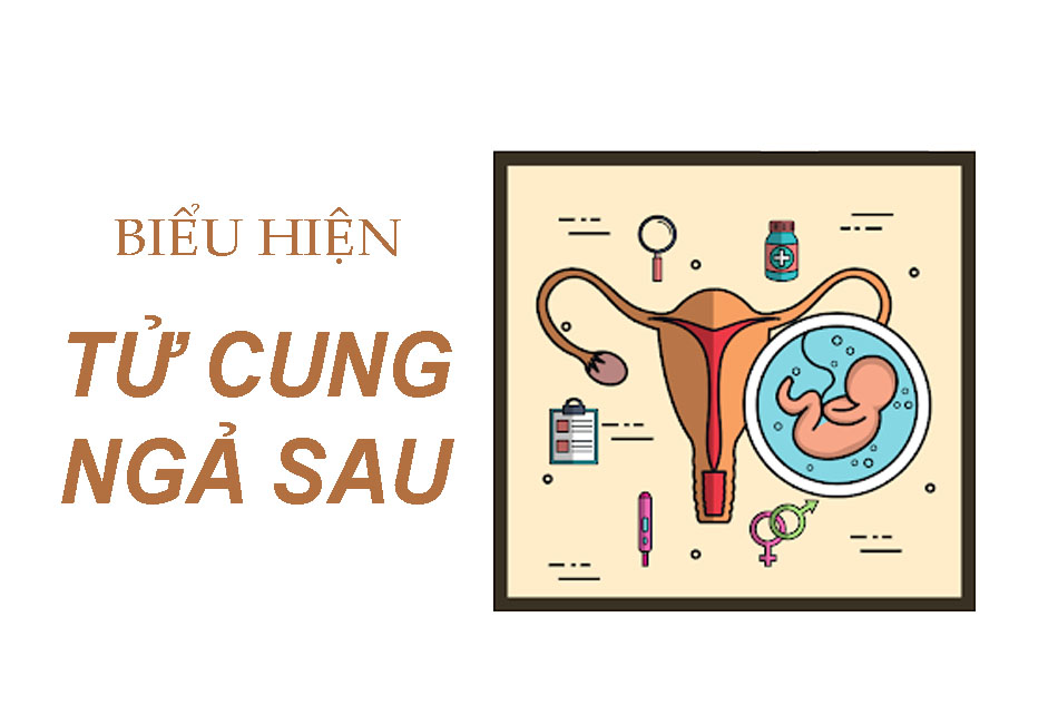 Biểu hiện tử cung ngả sau