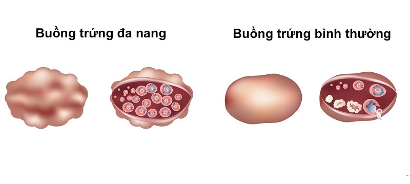 Buồng trứng có nhiều nang nhỏ có mang thai được không?