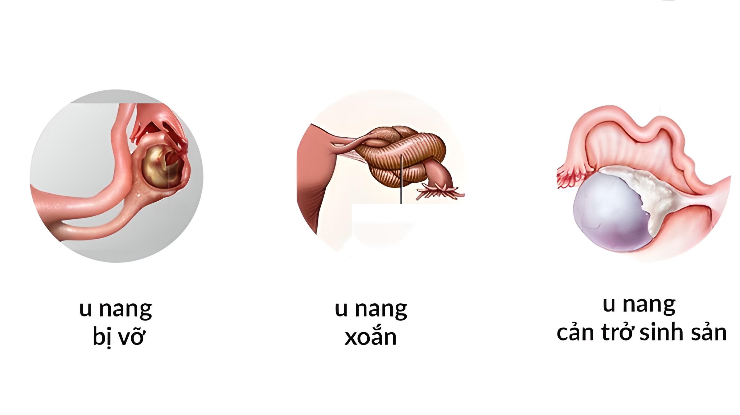 U nang buồng trứng có nguy hiểm không