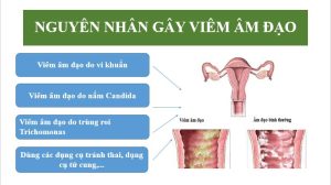 Viêm âm đạo: Xét nghiệm nào chẩn đoán chính xác