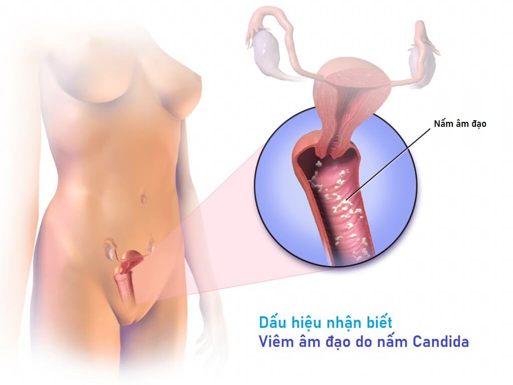  Viêm âm đạo do nấm Candida là vấn đề hay gặp ở phụ nữ