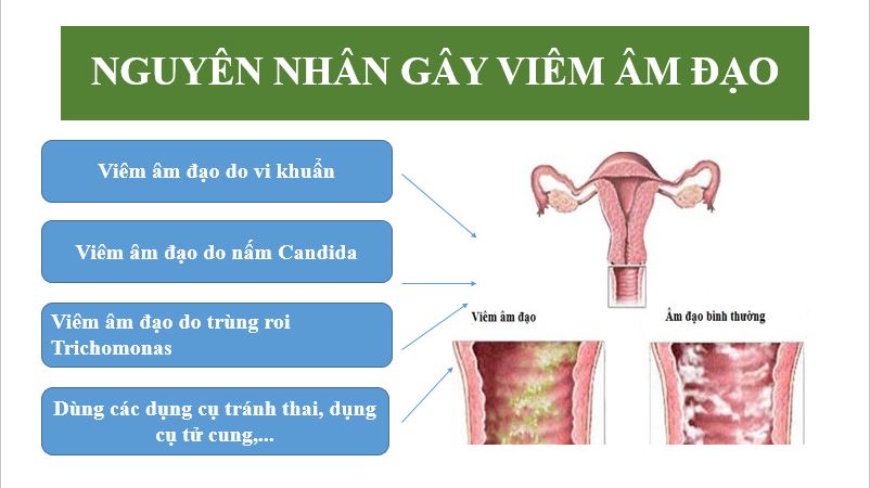 Phòng Ngừa Viêm Nhiễm Phụ Khoa Hiệu Quả