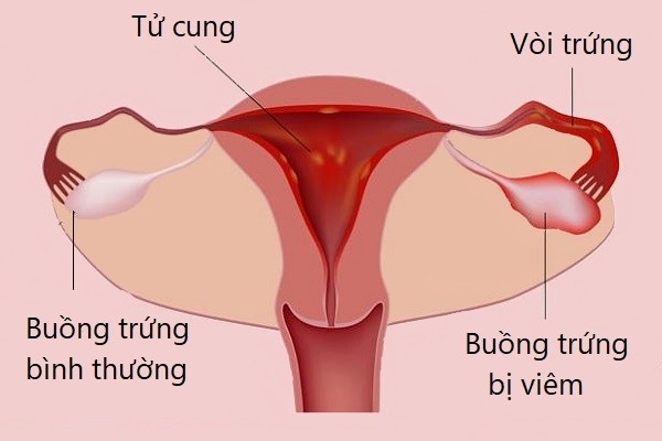 Viêm buồng trứng là tình trạng viêm phần phụ thường gặp.