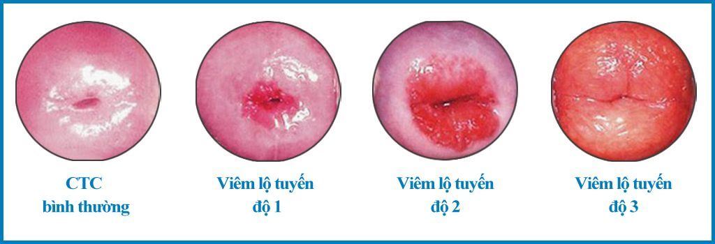 3 cấp độ của Viêm lộ tuyến cổ tử cung 