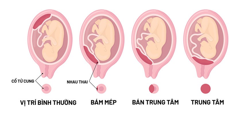 Các vị trí bám của rau thai