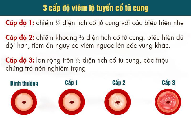 Viêm lộ tuyến cổ tử cung có nguy hiểm không?