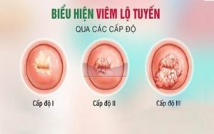 Triệu chứng và cách điều trị viêm lộ tuyến độ 3