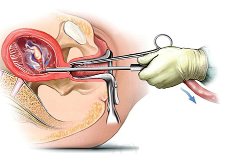 Thủ thuật không an toàn có thể tăng nguy cơ viêm lộ tuyến cổ tử cung