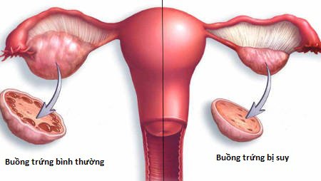 Suy buồng trứng sớm là nguyên nhân gây rối loạn kinh nguyệt nghiêm trọng