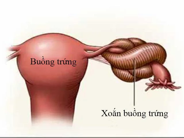 U nang buồng trứng xoắn là một cấp cứu, cần phải nhập viện ngay.