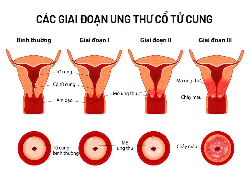 Ung thư cổ tử cung diễn biến âm thầm, có thể không có triệu chứng.