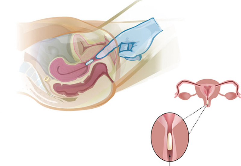 Điều trị đặt thuốc âm đạo trong viêm lộ tuyến 