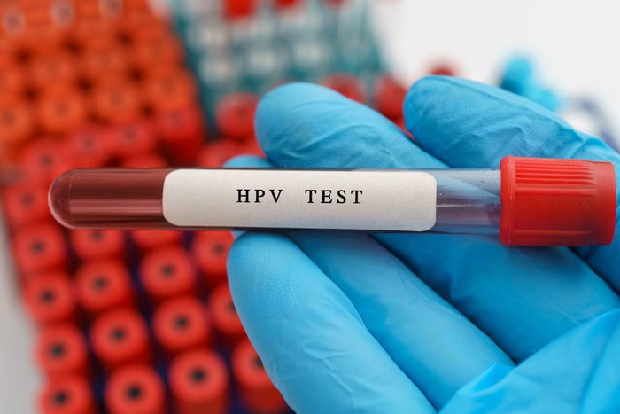 Test HPV góp phần phát hiện các chủng HPV có nguy cơ cao gây ung thư